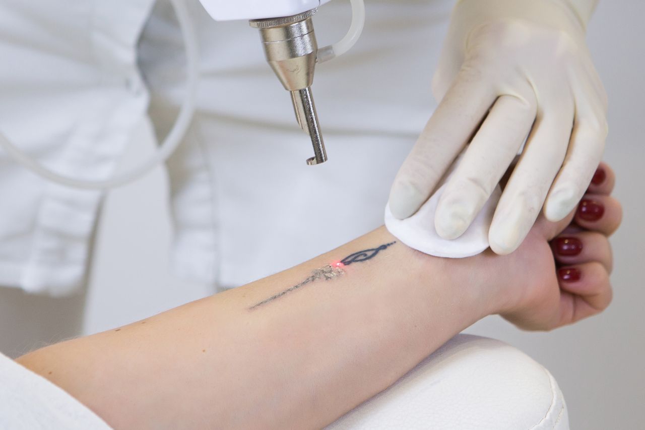 Usunięcie tatuażu – z czym się wiąże?