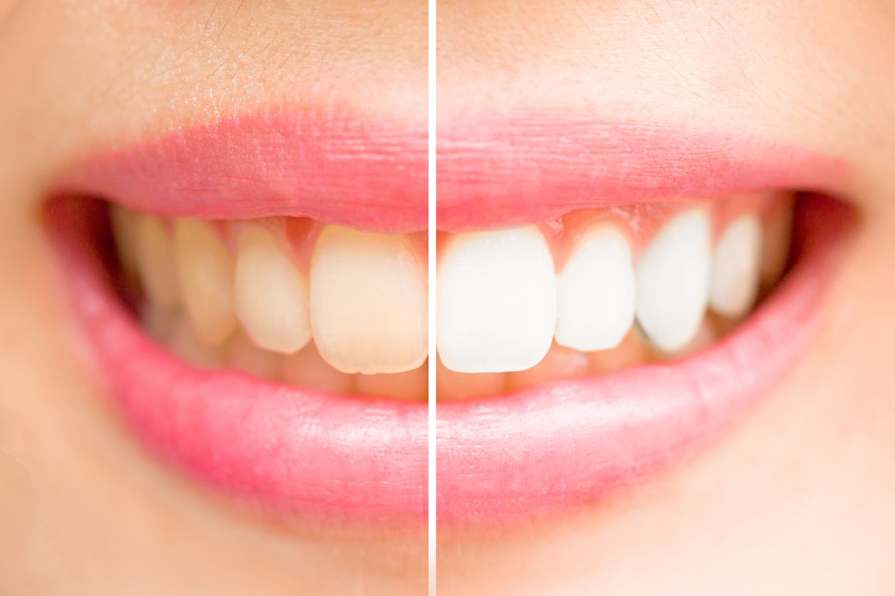 Wybielanie zębów – jakie są metody?